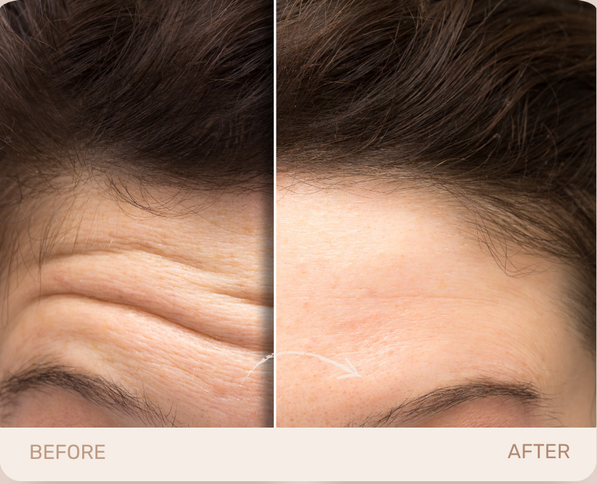 A woman 's forehead before and after botox.