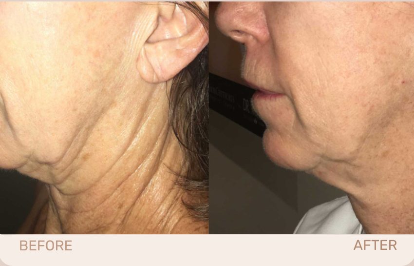 A woman 's face before and after the procedure.