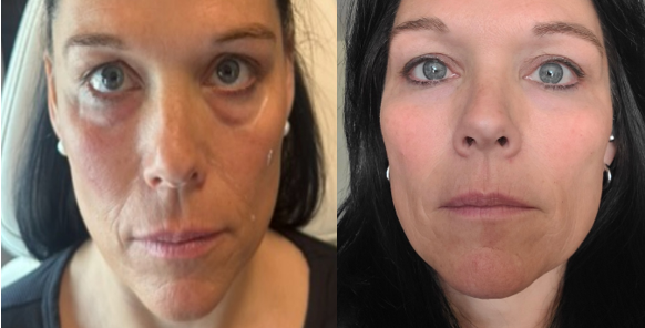 A woman with dark hair and blue eyes is before and after her surgery.