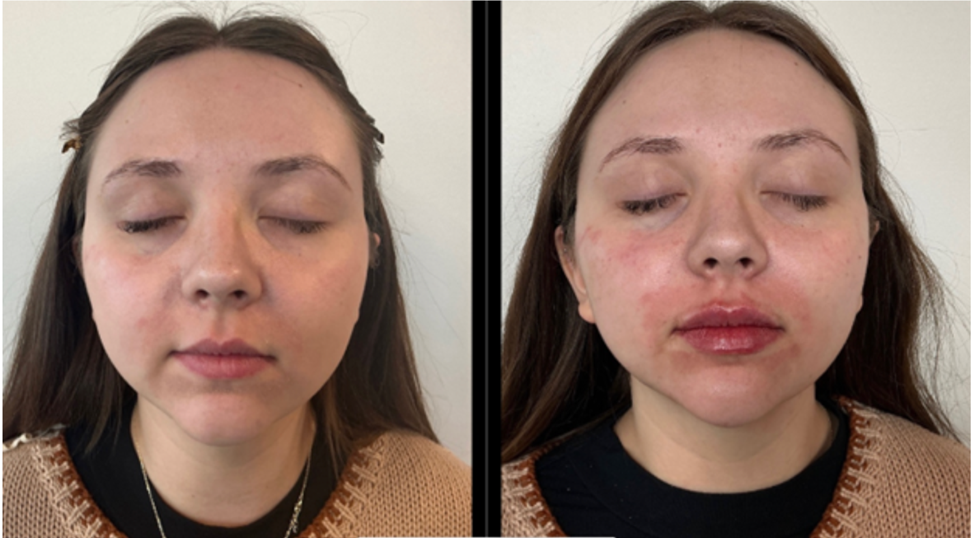 A woman with acne and swelling on her face.