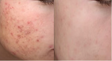 A before and after photo of the skin on someone 's face.